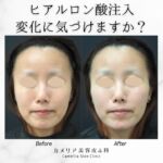 今回はヒアルロン酸注入の症例をご紹介します。

モニター様は30代、女性。
「以前は丸顔だったが、久しぶりに撮った証明写真で頬が痩せ、老けたような印象になっていたのがショックだった。若いころの印象に戻りたい。」とのことでした。

人間の目は「老けて見える」ということに、すぐ気づく能力がありますよね。
とても敏感なセンサーです。

ビフォーアフターの写真を見て、「どこが変わったか？」はわからなくても、「どこかが変わった！」ということには気づくのではないでしょうか。

🟦痩せたこめかみ・頬
🟦平坦な頬
🟦収縮した顎
🟦小鼻や口元の影

加齢に伴い現れてくる少しずつの変化が重なって「老けて見える」という印象を与えています。

その少しずつの変化に対して、今回注入を行いました。

加齢による骨格の変化をヒアルロン酸注入で戻していくとことで、自然な若返りが期待できます。

昔の顔立ちに戻るヒアルロン酸注入が気になる方はぜひご相談ください。

【治療内容】ヒアルロン酸注入
【使用薬剤】
　　ジュビダームビスタ®︎ ボラックスXC　1cc
　　ジュビダームビスタ®︎ ボリューマXC　2cc
【治療期間・回数】
１回
【費用】
１ccあたり￥66,000（税込み・診察料別・麻酔代別）
※その他、ボリュームディスカウント価格あり。
【起こりうる副作用・リスク】
内出血・腫脹・ボコつき・左右差・薬剤によるアレルギー・塞栓・血行障害など

#ヒアルロン酸注入 
#たるみ治療 
#リフトアップ治療