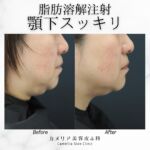 今回は脂肪溶解注射の症例のご紹介です😊

１回の治療で顎下のもたつきの改善が認められました😍

当院の脂肪溶解注射『ミケランジェロ』はイタリア製の製剤です💉

ミケランジェロには脂肪細胞を破壊し、代謝を促してくれる
【デオキシコール酸、ホスファチジルコリン、カルニチン、αリポ酸、カフェイン】
などが含まれています。

こんなお悩みはありませんか？

✅ 食事制限や運動は続かない
✅ 頑張ってダイエットしてるのに、顔や二の腕のお肉が落ちない
✅ 脂肪吸引は何だか怖い...
✅ ダウンタイムの少ない痩身治療がしたい！

そんなあなたには
脂肪溶解注射『ミケランジェロ』がおすすめです😉

注入することで脂肪を溶解し、体外に排出する作用があります💉
注入時の痛みも少なく、施術後の腫れも少ないため、ダウンタイムも短く、受けやすい治療となっております💁‍♀️

【治療内容】脂肪溶解注射（ミケランジェロ）
顎下、フェイスラインに10cc注入
【治療期間・回数】1回
【費用】ミケランジェロ1ccあたり 4,700円
(使用料目安：片手1枚分で5cc)
（税込み・診察料別）
【起こりうる副作用・リスク】赤み、腫れ、痛み
最後までご覧いただきありがとうございました✨

モニター様
写真の提供ありがとうございました✨

#美容皮膚科岐阜
#美容クリニック岐阜
#脂肪溶解注射
#デオキシコール酸
#部分痩せ
#二重顎
#ミケランジェロ
