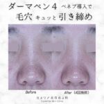 今回はダーマペン4(ベネブ導入)の症例紹介です。
症例モデル様は30代女性の方です。

afterはダーマペン4(ベネブ導入)のお施術を4回受けた後の経過のお写真です。
 
 
お悩みであった鼻の毛穴の開きが改善しています☺️
ダーマペンはコラーゲンを生み出す真皮層の線維芽細胞を刺激する作用があります。コラーゲンが増えることでお肌にハリが出て、毛穴が目立ちにくくなります。
 
お肌にハリがでることで、小じわも改善する作用があります。

【治療内容】
ダーマペン4(ベネブ導入)
 
【治療期間・回数】
令和6年7月~令和6年10月の間に4回施術
 
【費用】
ダーマペン4(ベネブ導入)【全顔】
初回トライアル ￥22,000
1回 ￥275,00、5回コース ￥123,750
 
※上記料金いずれも税込価格。
※初回トライアル、単発の場合は診察料発生します(初診料:￥2,200、再診料:￥1,100)
※コース消化の場合は診察料発生いたしませんが、他のお施術や内服の処方などご希望の場合は診察料発生します。
※外用麻酔料(￥2,200)はコース消化の都度発生します。
 
 
【起こりうるリスク・副作用】
赤み、痒み、腫れ，細菌感染、かさぶた、炎症後の色素沈着、皮下出血など
 
毛穴治療とひとくくりにいってもお施術の方法は何通りもあるので、「毛穴が気になるけど何から始めたらいいのか分からない💦」とお思いの方も多いと思います。
 
 
当院では肌診断機でお肌の状態を診させていただき、医師の診断のもと患者様に合わせたお施術を提案させていただきます。
美容施術が初めての方も安心して治療受けていただける環境を心がけて診療、施術を行っております🥰
 
 
美容クリニックが初めての方もお気軽にご相談下さいませ。
 
 
症例モニター様、お写真の提供ありがとうございました🙇🏻‍♀️