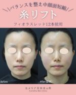 【30代女性｜フィオラスレッド 12本 糸リフト症例】

「20代の頃に比べて、頬がこけてきた気がする…」
 「中顔面が間延びして見える…」

そんなお悩みをお持ちだった30代女性の患者様に、
フィオラスレッドを12本使用した糸リフトを行いました✨

施術直後のお写真は麻酔の影響もありやや腫れていますが、
 頬の位置がしっかりと引き上がっているのがわかります👏

顔の土台から引き上げることで、
 お顔全体の印象もキュッと若々しく見えるのが糸リフトの魅力です💫

【治療回数】1回

【使用糸】フィオラスレッド 12本

【副作用・起こりうるリスク】
 出血・ボコつき・ひきつれ・左右差・腫れ・感染など

【術後の注意点】
 術後1ヶ月は、マッサージや歯科受診など、
大きく口を開ける動作は控えていただくようお願いいたします。

「下がった頬を、少し引き上げたい」
 そんな方におすすめの治療です🌸